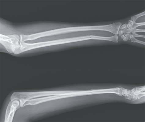 Isolated Ulnar Shaft Fracture – Home