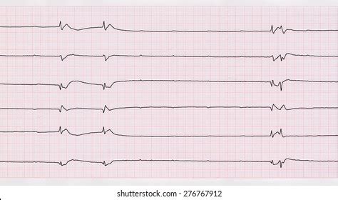 52 Asystole Ecg Images, Stock Photos, 3D objects, & Vectors | Shutterstock