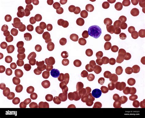 Polycythemia Vera Light Micrograph Of A Blood Smear From A Patient