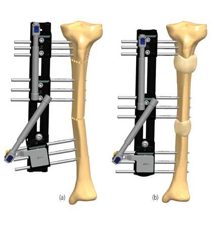 Correction Of Tibial Deformity With Lengthening Orthofix Abs