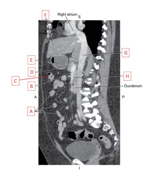 Diagram Of Sagittal CT Slice Of The Abdomen Quizlet