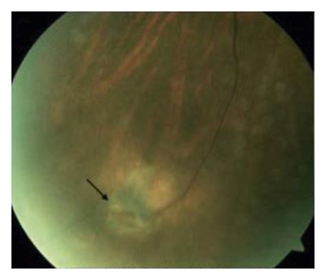 Peripheral SD OCT Of Lattice Degeneration With Vitreoretinal Traction