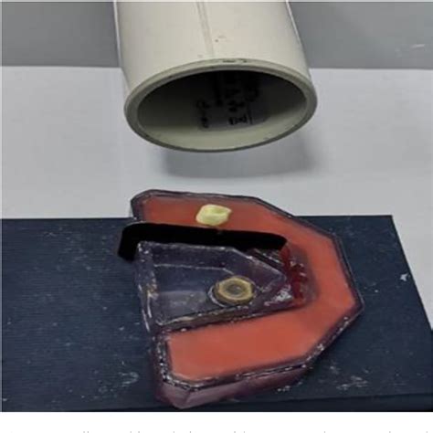 Figure From Pulpal Dressing Condensation Methods In Pulpotomy For