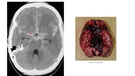 Subarachnoid Haemorrhage Youtube