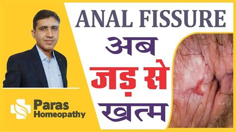 Fissure Treatment In Homeopathy Paras Homeopathy