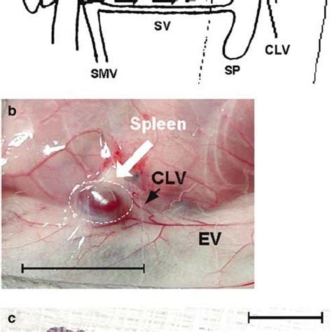 Subcutaneous splenic transposition. ( a ) Transposition of the spleen ...