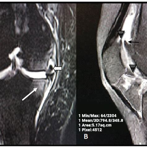 Advanced Osteoarthritis On Mri A Sagittal Stir Image Showing Advanced