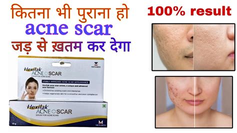 Hexilak Acne Scar Scar Hexilak Ultra Gel Use Benefits Review Hindi Review Of Hexilak Gel