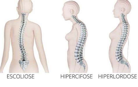 Anatom A Patol Gica De La Escoliosis Hipercifosis E Hiperlordosis