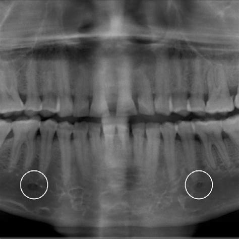 Sex Distribution Of The Mental Foramen Shape Among 320 Subjects