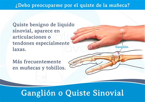 Ganglión o Quiste Sinovial