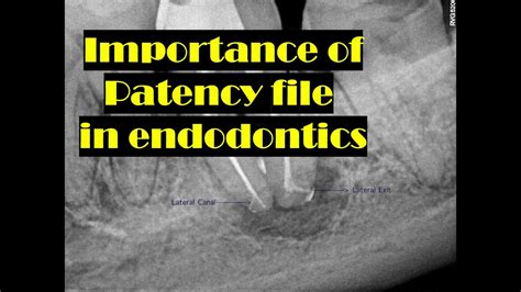 Importance Of Patency File YouTube