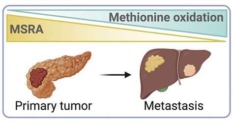 Scientists Find Trigger That Sets Off Metastasis in Pancreatic Cancer ...