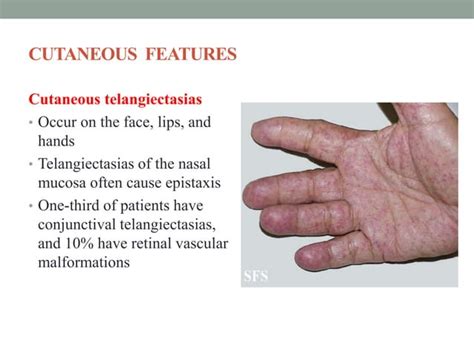 Neurocutaneous syndrome