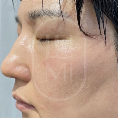 Laser Pigmentation Removal Sydney Lumi Skin Clinics