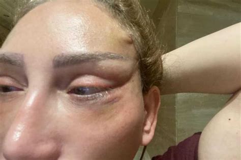 Impactantes imágenes del rostro de Reham Saeed tras una cirugía