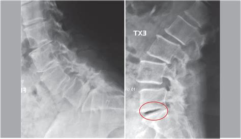 Vacuum Disc Phenomenon Mri at lukegfarmer blog