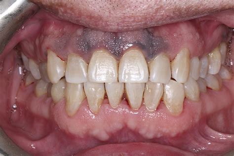 Oral Malignant Melanoma Gums