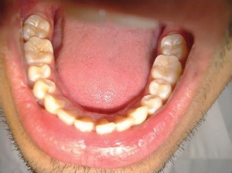 Maxillary And Mandibular Molars