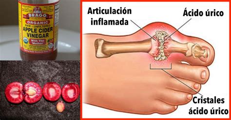 Cómo eliminar rápidamente la cristalización de ácido úrico de su cuerpo