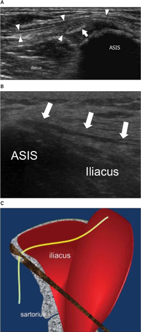 Meralgia Paresthetica Injection Technique