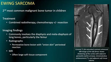 Cincy Kids Radiology on Twitter: "Ewing sarcoma is the second most ...