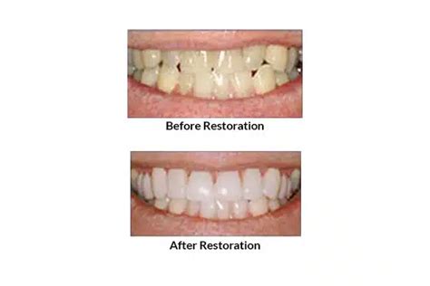 Lumineers Vs Veneers Before After