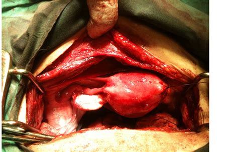 Case Report Of Surgical Excision Of Non Communicating Rudimentary Horn