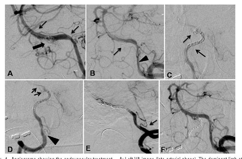 Structure Of Superior Hypophyseal Artery Semantic Scholar