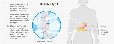 Diabetes Mellitus