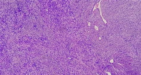 Photomicrograph of a schwannoma, a benign soft tissue tumor of ...