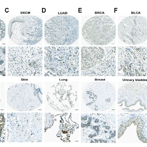 The Protein Expression Level Of Il In Human Multiple Cancer Tissues