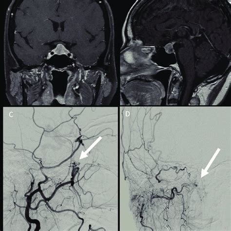 Pituitary tumor with suprasellar growth and involvement of optic ...