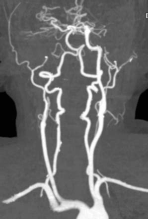 Acute bilateral internal carotid artery occlusion | Radiology Case ...