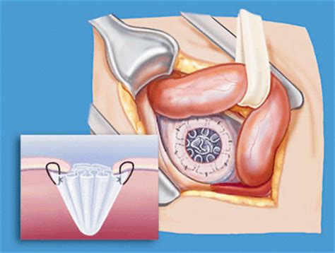 Inguinal Hernia Repair Mesh