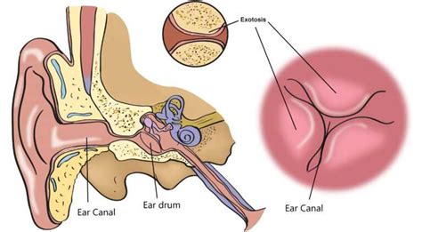 External auditory exostosis (EAE) - ENT Info