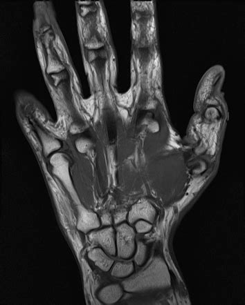 Acute Calcific Periarthritis Radiology Case Radiopaedia Org