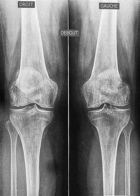 Osteoarthritis Of The Knees Photograph By Brian Gadsby Science Photo