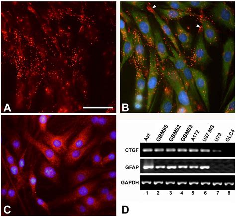 Ctgf Is Expressed By Gbm Cells Double Immunostaining Showing Ctgf A