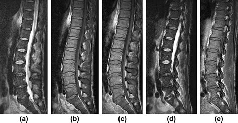 The Mri Appearances Of Early Vertebral Osteomyelitis And Discitis