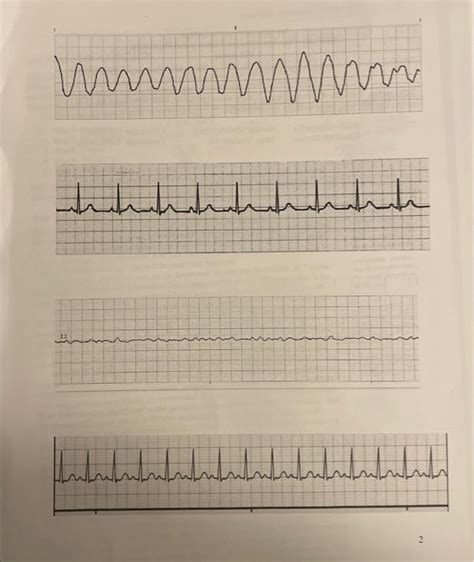 ECG strips. For each strip complete the 6 steps to | Chegg.com