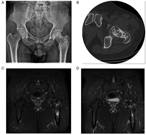 Aneurysmal Bone Cyst Spine Mri