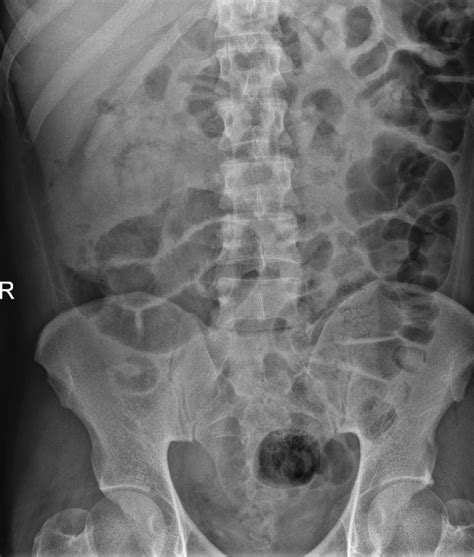 Combination Of Ectopic Pancreas And Intestinal Malrotation Presenting As Non Specific Right