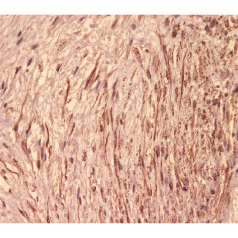 Photomicrograph Ihc Stain Original Magnification ×40 Of Tumor Cells