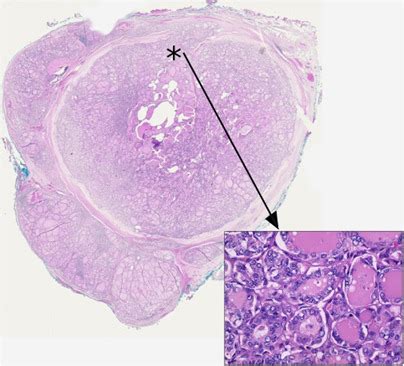 Papillary Thyroid Carcinoma An Update Modern Pathology