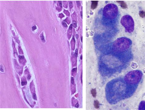 Pathology Of Bone Flashcards Quizlet