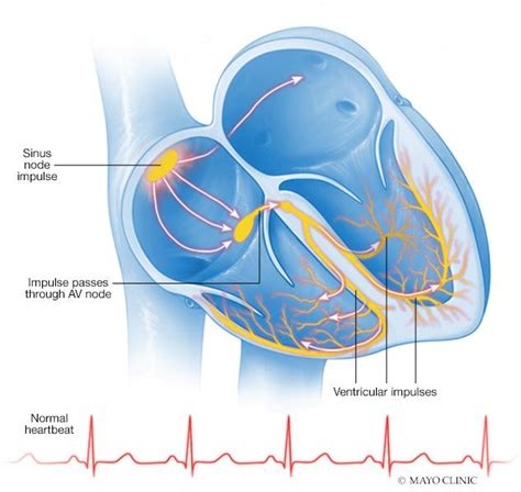 What Is A Heart Arrhythmia Mayo Clinic News Network