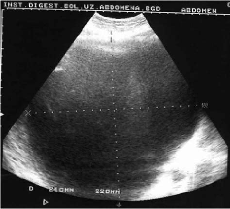 Ultrasound scan of the huge liver cyst. Figure 2. MRI demonstrating the ...