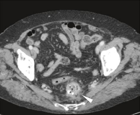 Figure 3 from Mesh erosion into the rectum after laparoscopic posterior rectopexy: A case report ...