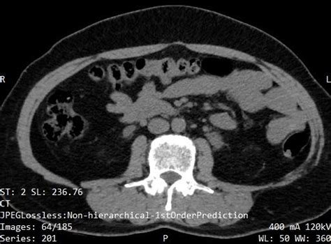 Kidney Tumor Detection Instance Segmentation Dataset by Imran Riaz Chohan